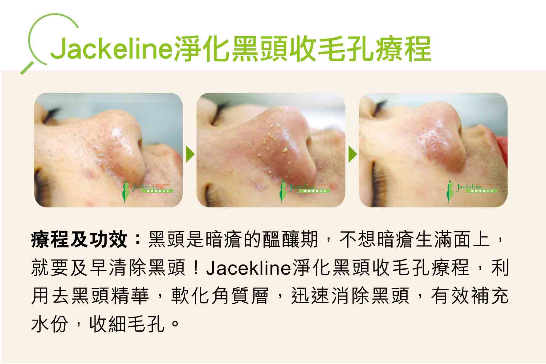 Jackeline淨化黑頭收毛孔療程